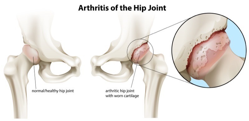 Illustration of a hip joint with arthritis.
